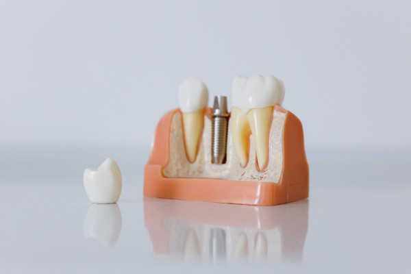 Implantes Dentários